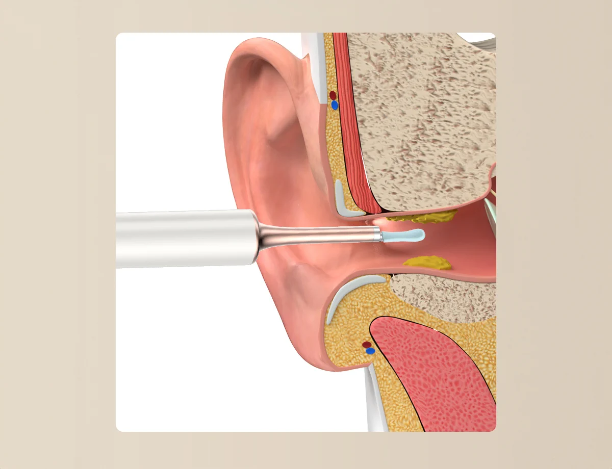 BEBIRD T15 OTOSCOPIO CON CAMARA PARA DEPILACION BLANCO