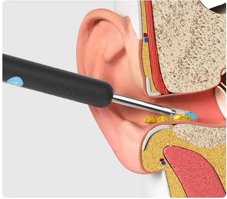 BEBIRD R1 OTOSCOPIO CON CAMARA LIMPIA OIDOS BLANCO